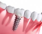 Zahnarztpraxis Matthias Krecker - Zahnimplantat