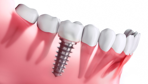 Zahnarztpraxis Matthias Krecker - Zahnimplantat