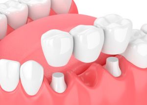 Zahnarztpraxis Matthias Krecker - Zahnersatz